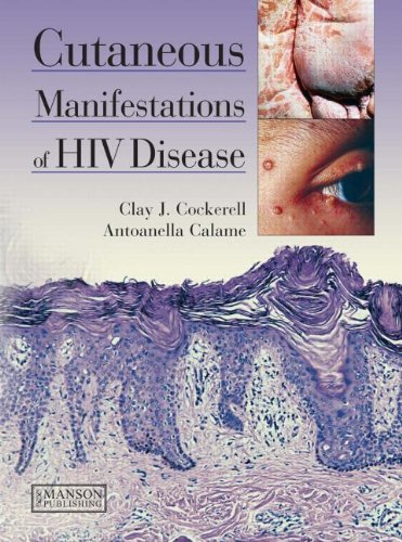 Cutaneous Manifestations of HIV Disease [Hardcover] [2012] (Author) Clay Cockerell, Antoanella Calame