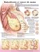 Understanding Breast Cancer Chart (Spanish - Entendiendo el cancer de mama) - Unmounted Paper ----------------------------------------------------------------------------------------------- Now in Spanish, this chart provides essential visual and textual information about the most common form of cancer in women. Provides definitions of breast cancer and the most common types of the disease. Illustrates breast anatomy and shows the common types of breast cancer. Lists signs & symptoms and causes of breast cancer. Illustrates and describes the stages of breast cancer. Provides instruction for breast self examination (BSE). Chart Mounting Information - UNMOUNTED PAPER: Printed on high-quality, heavy paper. Get an unmounted chart if you are going to frame it, or if you just want to tape or tack it up on a wall. Our human anatomical charts measure 20"W x 26"H, and our animal anatomy charts are 26"W x 20"H. (Note: Unmounted charts cannot be displayed on the chart stands).