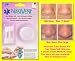 Snoring and Sleep Apnea Aid. Nasivent 100% Grade Medical Soft Silicone Nose Dilator. Increase Oxygen and Lowers High Blood Pressure.