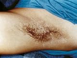 Body Hair Test for Drugs of Abuse