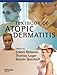 Textbook&nbsp;of&nbsp;Atopic&nbsp;Dermatitis&nbsp;(Series&nbsp;in&nbsp;Dermatological&nbsp;Treatment)