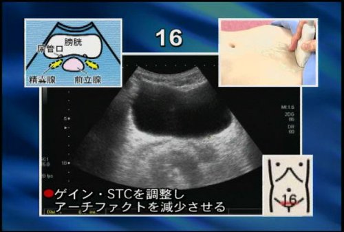“の”の字2回走査法で出来る! 超音波手技大原則〈第3巻〉 ケアネットDVD