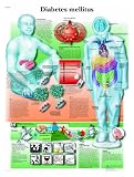 3B Scientific Lehrtafel – Diabetes mellitus