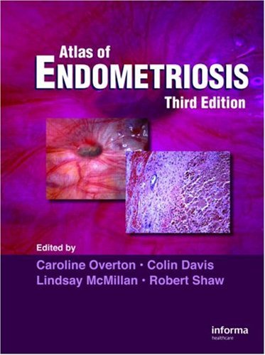 Endometriosis