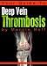 Your Guide To Deep Vein Thrombosis