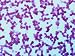 Anemia Iron Deficiency Low Erythrocyte Count Photographic Poster Print, 16x12