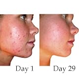 Acne Trio – Acne Skin Care Treatment, Vegan with Natural Ingredients – Unique Acne Clearing System – Creamy Cleanser, Milky Toner, Acne Moisturizer
