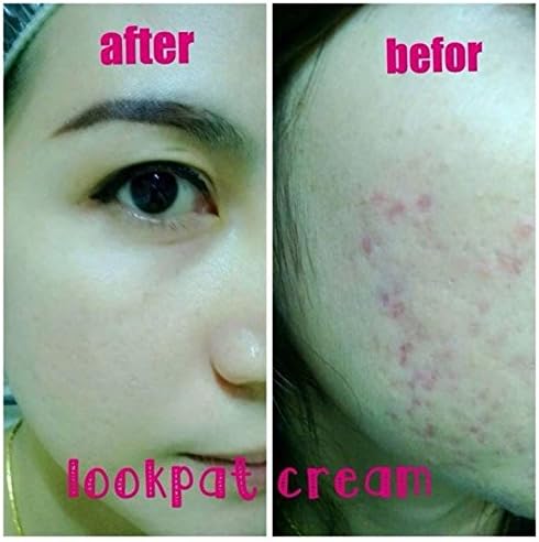 Whitening Cream Face, Anti Acne Cream Lookpat Cream V.2 Skin Lightening 5 G