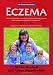   - Eczema