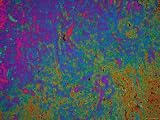Skin Cancer Human Photomicrograph Photographic Poster Print, 40x30
