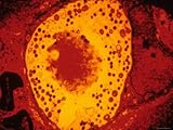 Chlamydia Trachomatis Tem Urethitis and Cervicitis Photographic Poster Print, 24x18