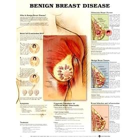 Click here to buy Benign Breast Disease Anatomy Styrene Plastic Chart by Anatomical Chart Company.