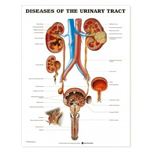 Chart - Diseases of the Urinary Tract by Lake Forest Anatomicals Organ Models