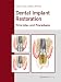 Dental Implant Restoration: Principles and Procedures
