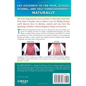 Healing Psoriasis: The Natural Alternative