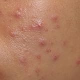 Natural Acne Treatment