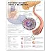   - Understanding Type 1 Diabetes Anatomical Chart (Laminated)