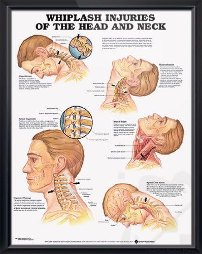 Whiplash Injuries of The Head and Neck, DeuPair 20x26" Pocket Frame Human Anatomy Poster