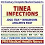 21st Century Complete Medical Guide to Tinea Infections, Jock Itch, Ringworm, and Athletes Foot, Authoritative Government Documents, Clinical References, and Practical Information for Patients and Physicians