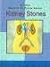 Image of All You Wanted to Know About Kidney Stones