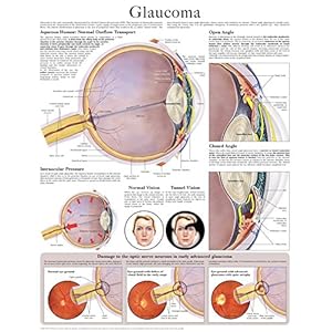 Glaucoma e chart: Full illustrated