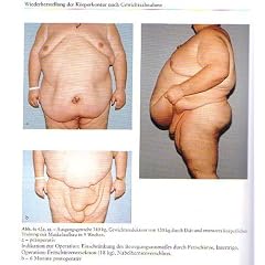 Morbide Adipositas. Klinik und chirurgische Therapie
