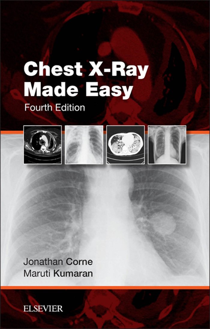 Chest X-Ray Made Easy - Kindle edition by Jonathan Corne, Maruti ... Chest X-Ray Made Easy - Kindle edition by Jonathan Corne, Maruti ...