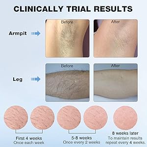 Permanent Laser Hair Removal For Women Men Imene 500 000