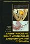 Arrhythmogenic Right Ventricular Cardiomyopathy/Dysplasia
