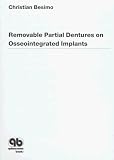 Removable Partial Dentures on Osseointegrated Implants