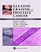 Gleason Grading Of Prostate Cancer A Contemporary Approach