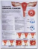 71Rg7F4LpQL. SL160  Understanding Cervical Cancer Anatomical Chart  9780781776547   Quantity 1