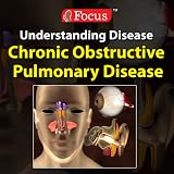 (COPD) Chronic Obstructive Pulmonary Disease (COPD) Chronic Obstructive Pulmonary Disease