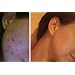 Best acne treatment products