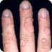Get Rid of Warts Forever Get Rid of Warts Forever