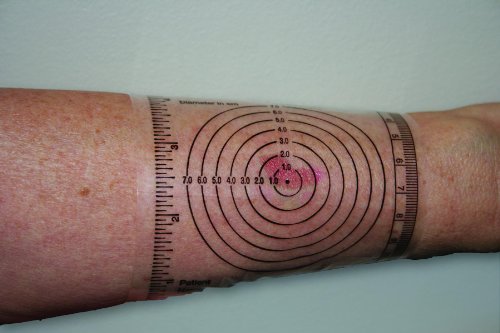 Ib Disposable Wound Measurement Guide 250
