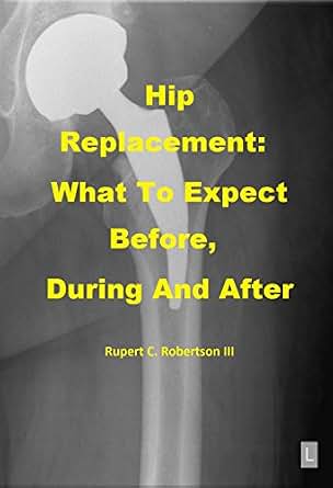 What To Expect After Hip Replacement Timeline – PNFAV