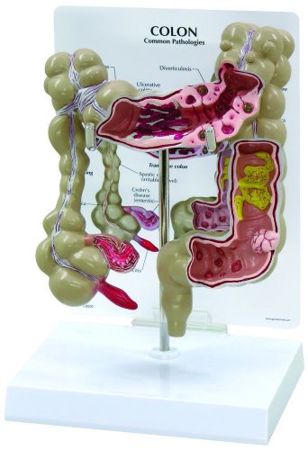 Colon Human Anatomical Model with Pathologies