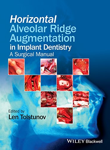 Algopix Similar Product 8 - Horizontal Alveolar Ridge Augmentation