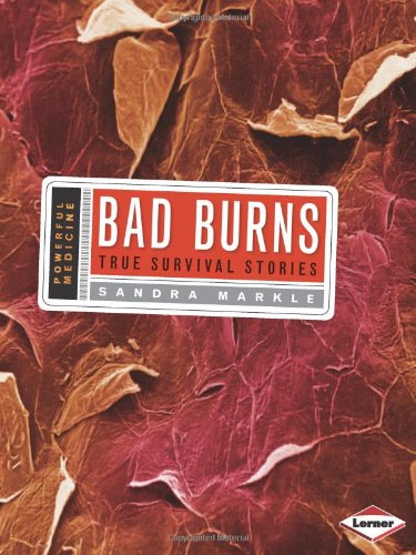 Bad Burns: True Survival Stories by Sandra Markle