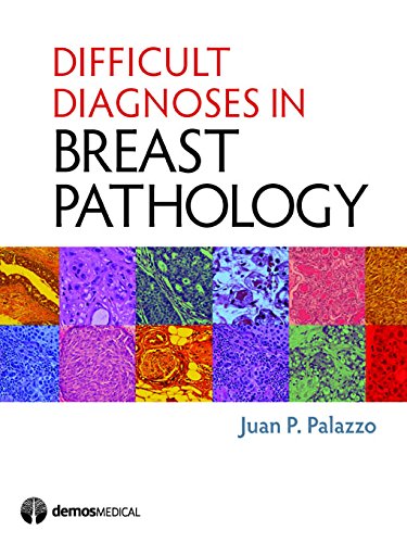 Difficult Diagnoses in Breast Pathology by Juan P. Palazzo MD