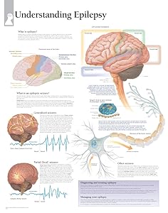 Understanding Epilepsy chart: Laminated Wall Chart by Scientific Publishing Scientific Publishing