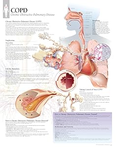 COPD chart: Laminated Wall Chart: Laminated Wall Chart
