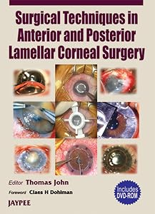 Surgical Techniques in Anterior and Posterior Lamellar Corneal Surgery