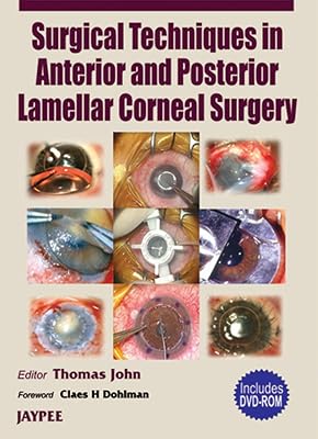 Surgical Techniques in Anterior and Posterior Lamellar Corneal Surgery
