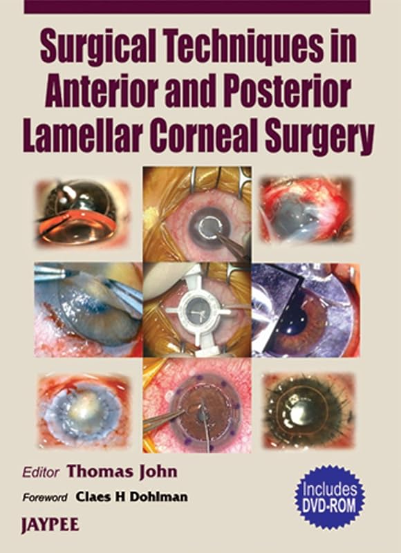 Surgical Techniques in Anterior and Posterior Lamellar Corneal Surgery by JOHN