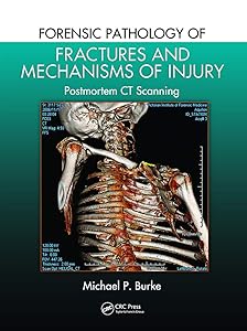 Forensic Pathology of Fractures and Mechanisms of Injury: Postmortem CT Scanning by Michael P. Burke