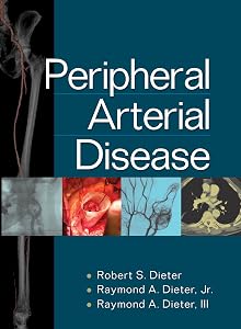 Peripheral Arterial Disease by Robert S. Dieter