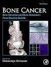 Bone cancer : bone sarcomas and bone metastases - from bench to bedside