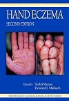 Hand Eczema (Dermatology: Clinical & Basic Science)